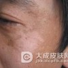 男人为何也会长黄褐斑