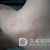 慢性荨麻疹注意事项