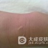 荨麻疹会给身体健康造成怎样的影响呢