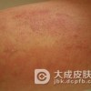 药疹和药物过敏有区别吗