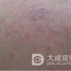 脂溢性皮炎患者如何健康饮食