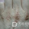手部湿疹具有哪些常见的症状表现呢