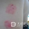 青少年得了银屑病的症状有哪些