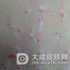 女性银屑病的原因有哪些