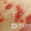 银屑病是与遗传密切相关的疾病