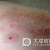 银屑病日常饮食如何安排