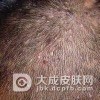 头癣的传染途径有什么