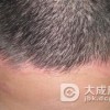 儿童头癣的护理重点是什么呢