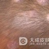 日常导致头癣的原因有哪些呢