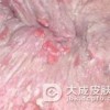 肛门周围皮肤发痒是得了湿疹的症状吗
