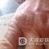 皲裂性湿疹的医治办法