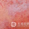 皲裂性湿疹的危害有哪些呢
