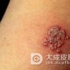 面部脂溢性皮炎的日常护理