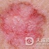 红斑狼疮忌一下三种食物
