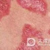 红斑狼疮的日常护理该怎么做