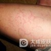 红斑狼疮的预防护理应该怎么样做