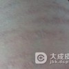 红斑狼疮会对人体形成哪些伤害