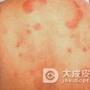 红斑狼疮属于自身免疫性的疾病