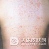 干性脂溢性皮炎有什么特点