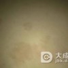 治疗花斑癣的方法有什么