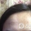 花斑癣应该怎样治疗
