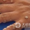 淋病是根据哪些症状诊断的