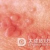 不同人群患上淋病会出现哪些症状