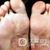 淋病的表现形式是什么样的