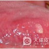 预防淋病应该注意的生活细节