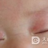 惊！眼部血管瘤可导致失明