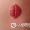 4个特殊部位的淋巴血管瘤需注意