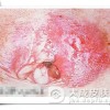 外阴白斑治疗期间要如何进行护理