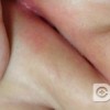 治疗外阴白斑需要多少钱