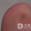 扁平寻常狼疮最好治疗方法