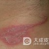 儿童异位性皮炎