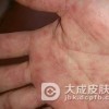 专家解析梅毒患者的症状