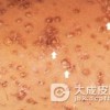 三期梅毒的症状变化