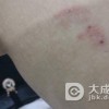 三期的梅毒患者会出现哪些症状