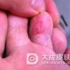 怎样治疗脚气病