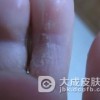 脚气与脚气病能混为一谈吗