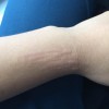 慢性荨麻疹应怎样预防