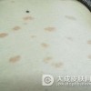得了玫瑰糠疹有什么危害呢