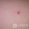 疱疹样皮炎冬季护理原则有什么