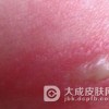 疱疹样皮炎有什么食疗方法呢