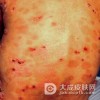 得了疱疹样皮炎怎么办呢