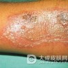 毒隐翅虫皮炎怎么预防