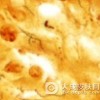 怎样治疗一期梅毒