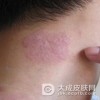 牛皮癣症状怎样治疗好