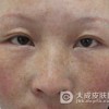 有效去除雀斑的方法是什么呢