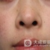 生活中预防雀斑方法